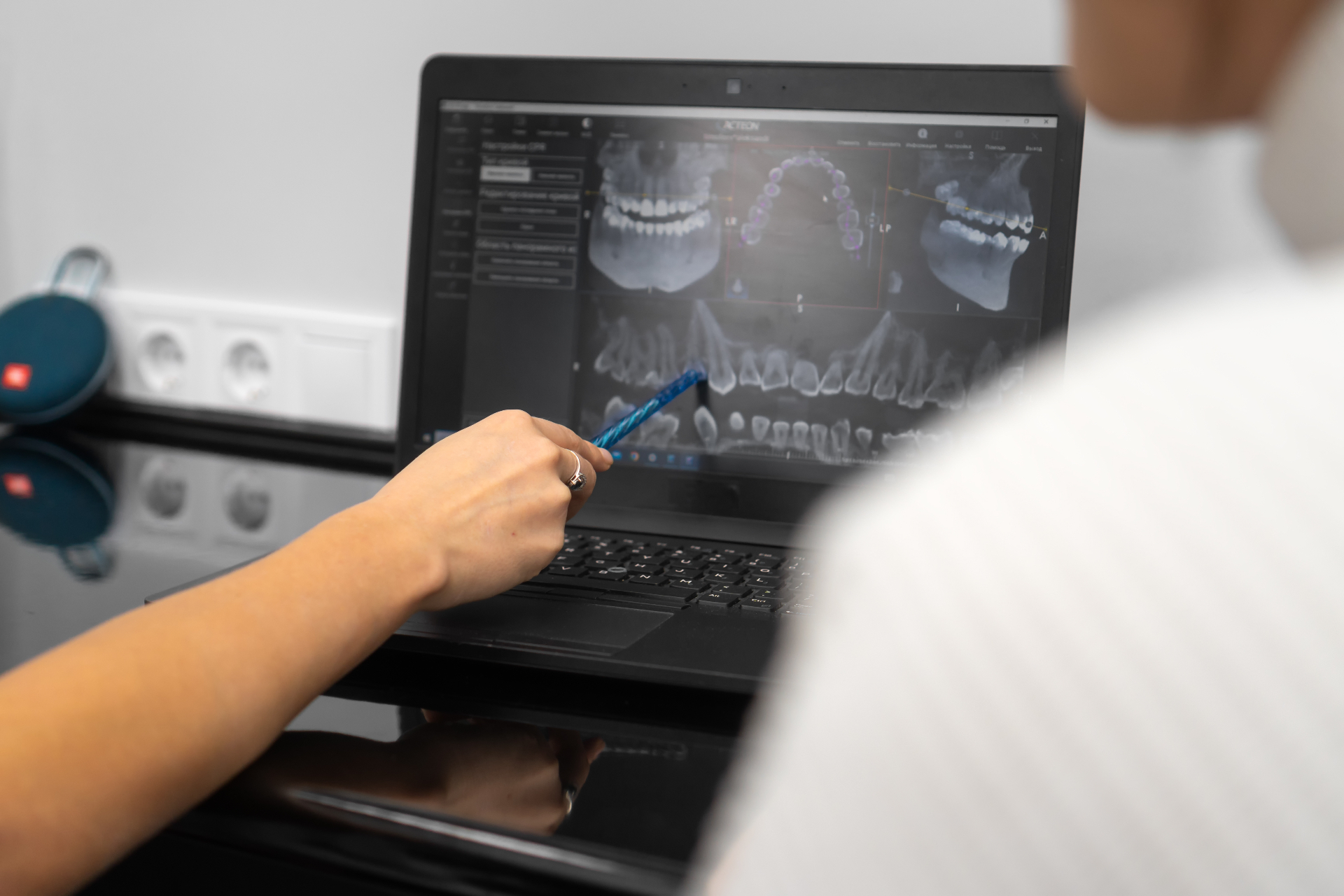 Dental professional pointing at CBCT jaw scans on a laptop during an All-on-4 consultation