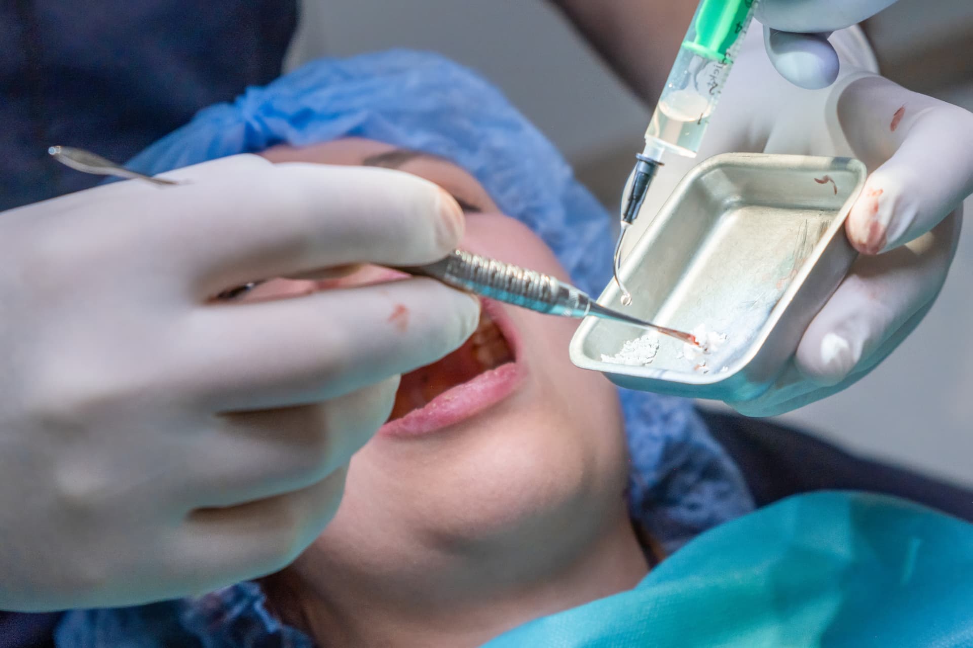 Dental surgeon preparing bone graft material in a sterile dish during a dental implant bone graft procedure