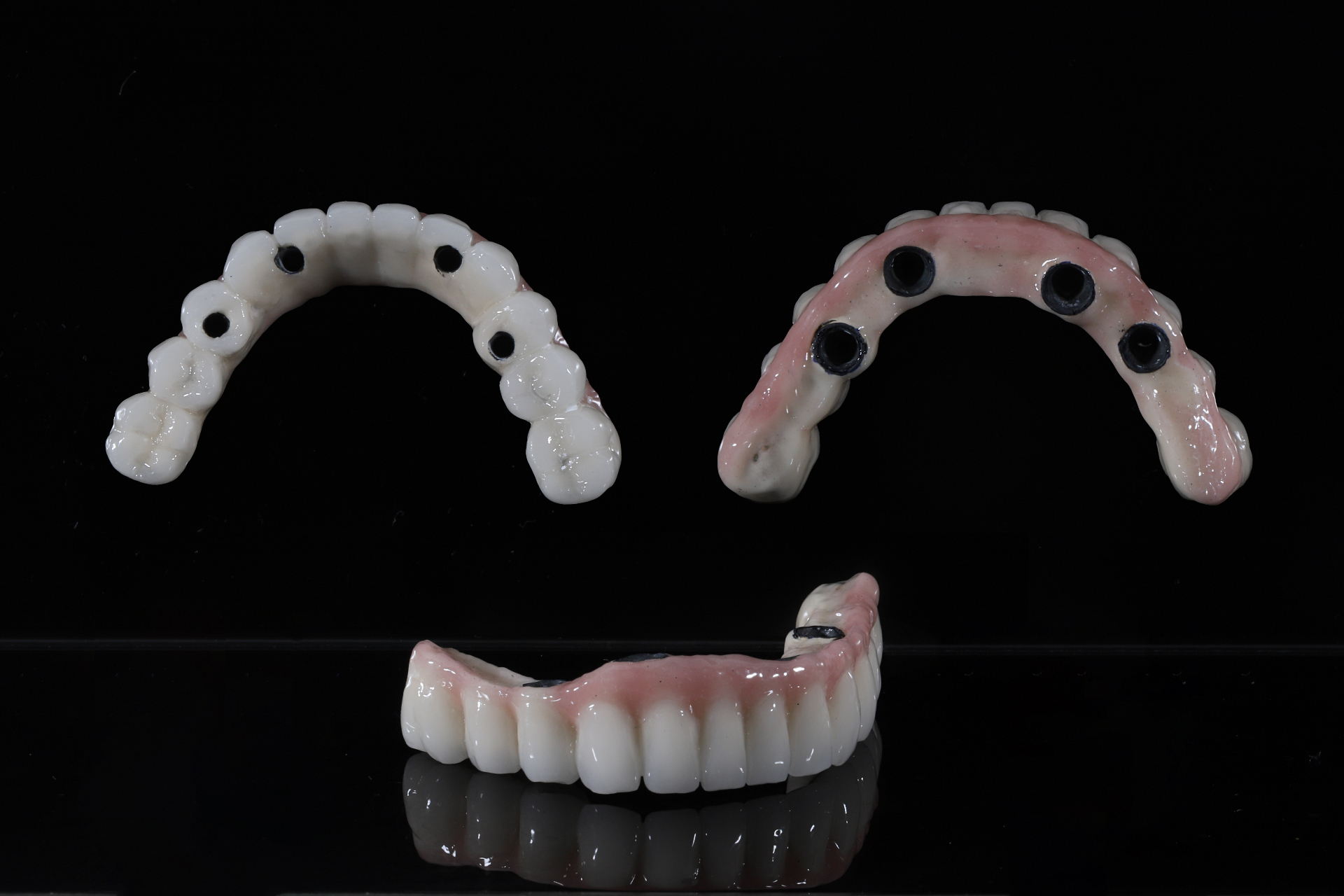Full-arch All-on-4 implant bridges showing the screw access holes that secure each prosthesis to four implants